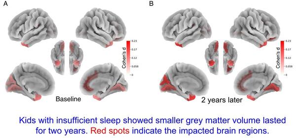 수면부족 어린이의 뇌 회백질(붉은색) 영역. 회백질은 의사결정, 충동 조절, 기억 등을 담당하는데 충분한 수면을 취한 어린이보다 부피가 적은 것으로 나타났다. /메릴랜드 의대