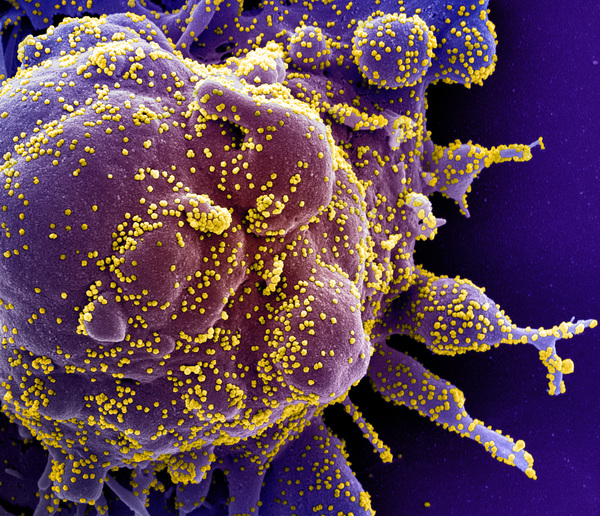 코로나19 감염 환자의 세포를 전자현미경으로 촬영한 이미지. 세포(보라색) 전체에 코로나19 바이러스(노란색)가 증식돼 있다. /미 국립보건원(NIH)