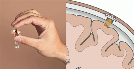 뉴럴링크의 칩(왼쪽)과 뇌에 삽입한 예상 단면도